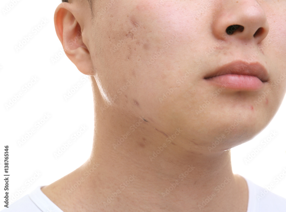 Young Asian man with problem skin on white background, closeup Young Asian man with problem skin on white background, closeup