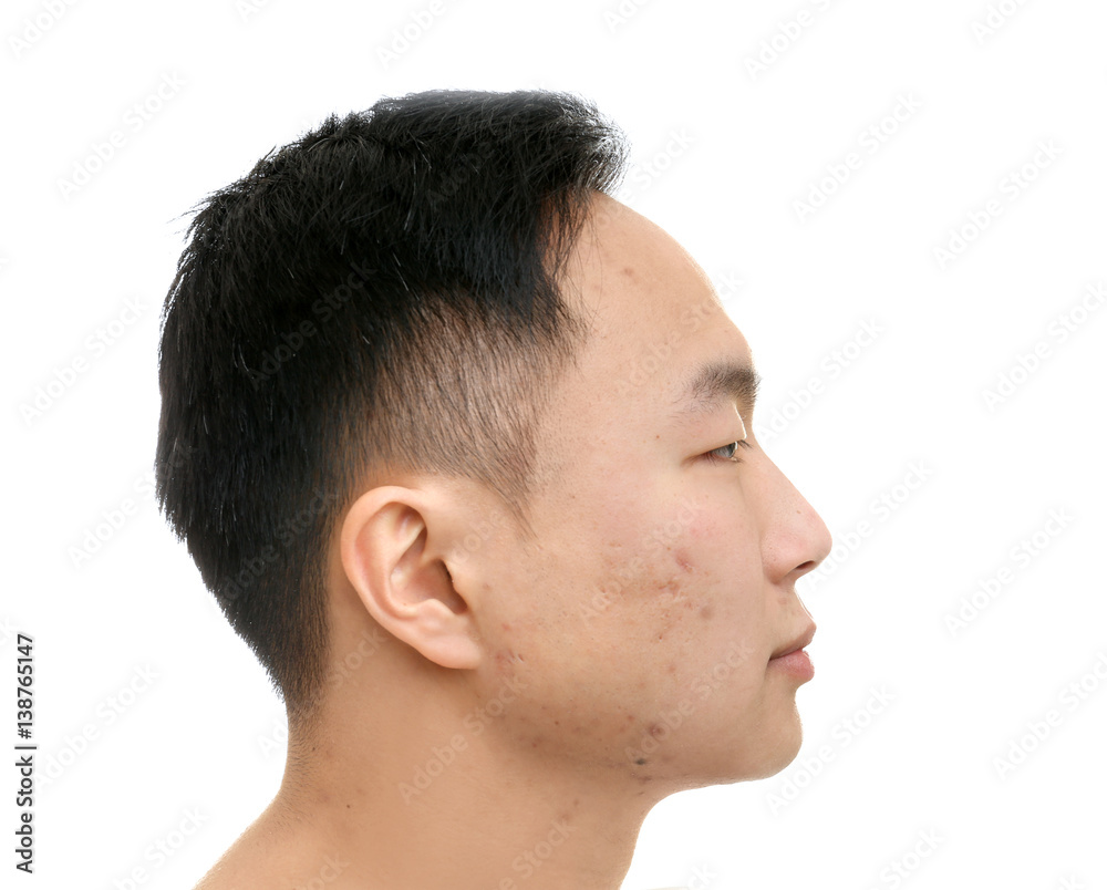 Young Asian man with problem skin on white background Young Asian man with problem skin on white background