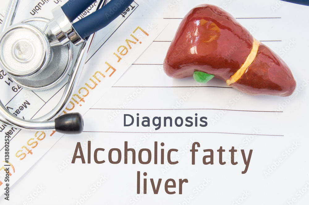 Alcoholic fatty liver diagnosis. Anatomical 3D model of human liver is