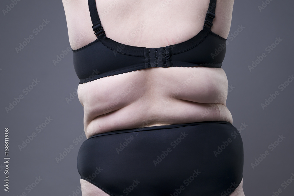 Fat Woman With Irritated Skin Under Bra, Irritation On The Body From  Underwear On Gray Background, Painful Area Highlighted In Red Stock Photo,  Picture and Royalty Free Image. Image 161237482.