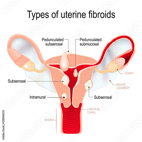 types of uterine fibroids: subserosal, intramural, submucosal, and pedunculated fibroids. photo