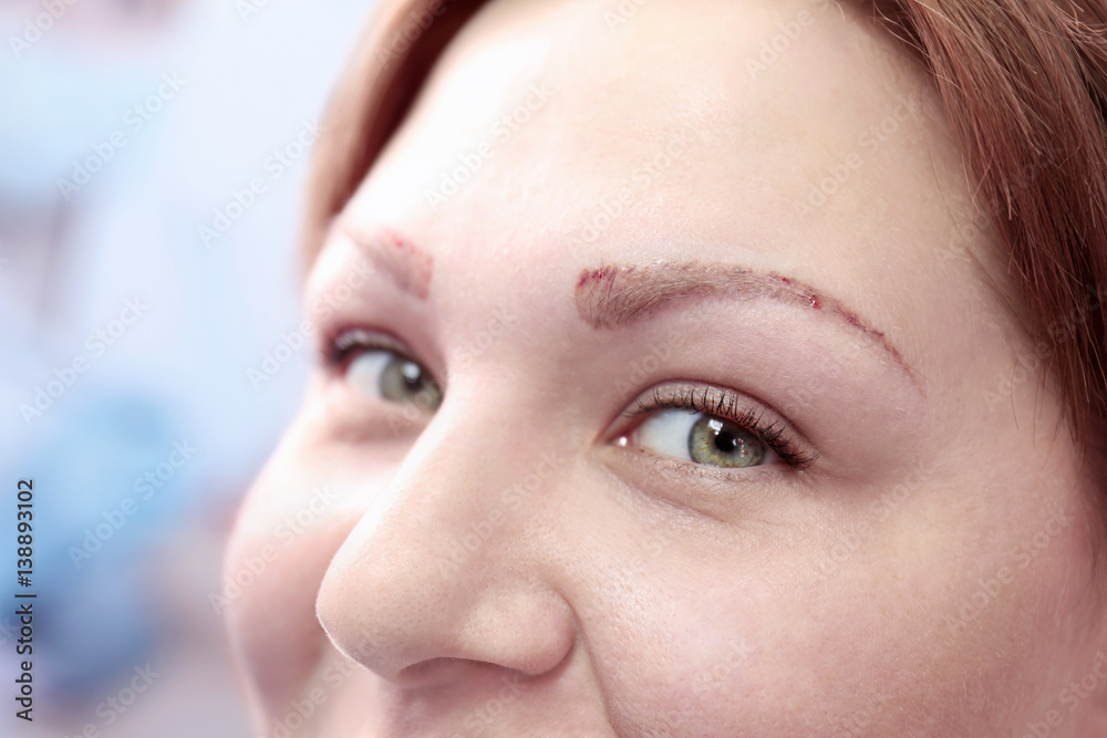Woman in process of eyebrow tattoo removal Woman in process of eyebrow tattoo removal