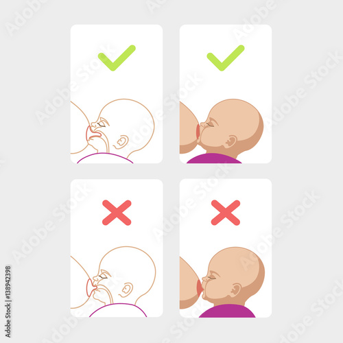 Correct breastfeeding position. Mother feeds baby with breast. Incorrect pose. Mom lactation infant milk.