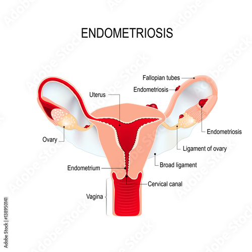 Endometriosis