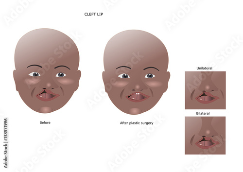black child with cleft lip, before and after surgery