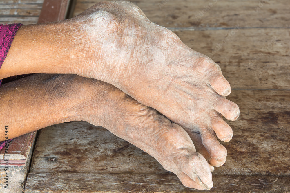 Fototapeta premium old dirty feet