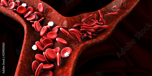 Sickle cell anemia, showing blood vessel with normal and deformated crescent. 3D illustration photo