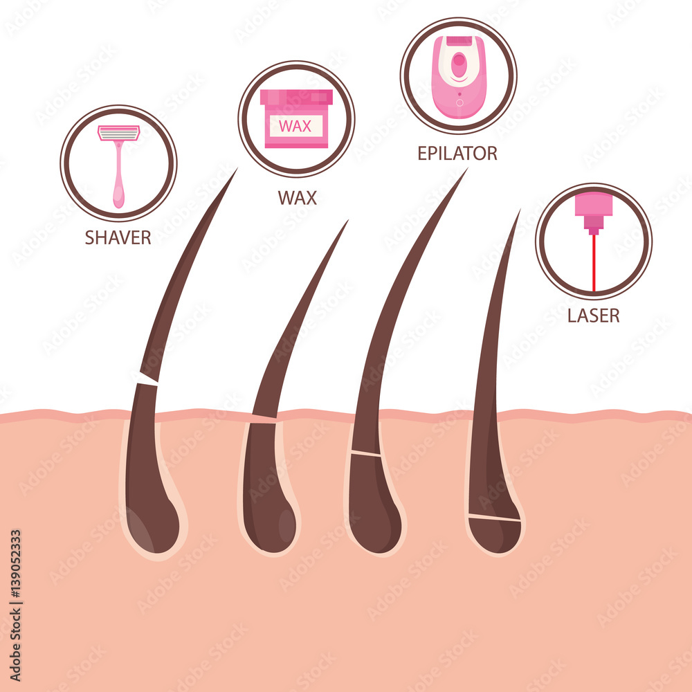 Modern vector illustration of different methods of hair removal. Types