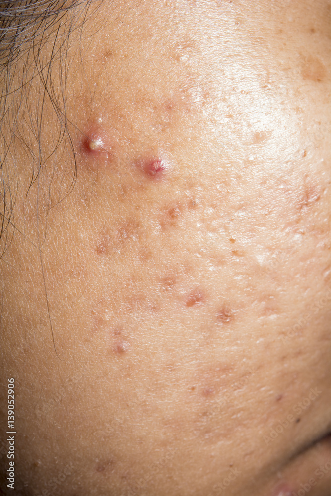 Fototapeta premium closeup for acne on face