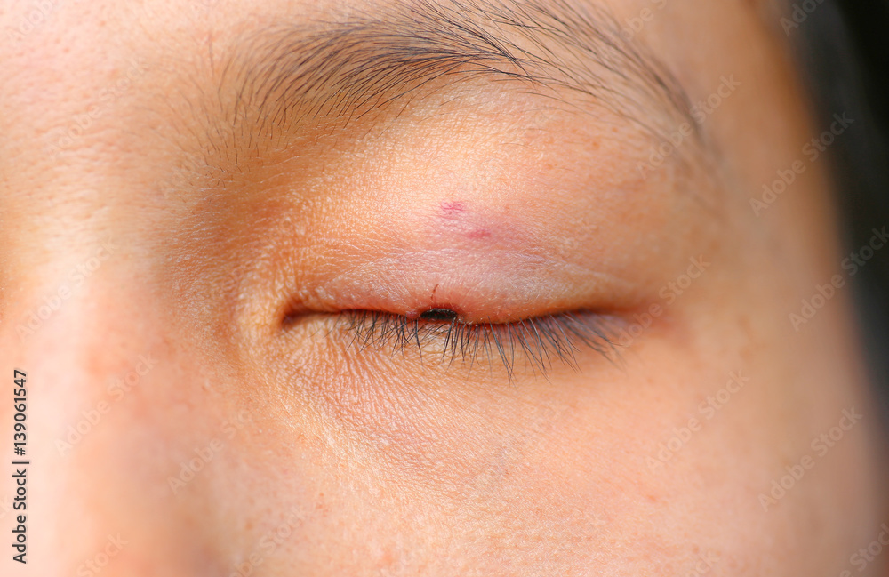 Fototapeta premium The wound medicine at eyelid, After removal fleck or birthmark by laser.