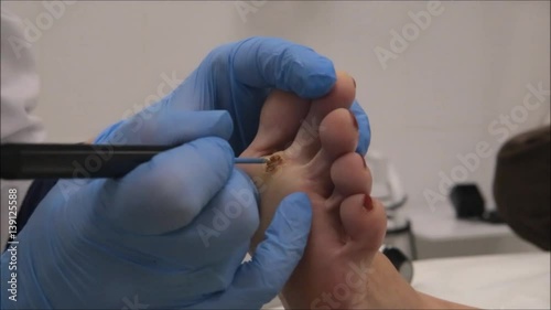 Dermatologist surgeon to cauterize wound after surgical operation of plantar wart removal using electrocautery tool
