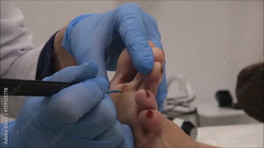 Dermatologist surgeon to cauterize wound after surgical operation of