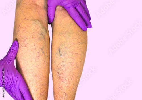 Lower limb vascular examination because suspect of venous insufficiency