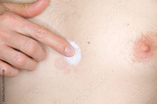 Brust eines jungen Mannes mit Hautpilz