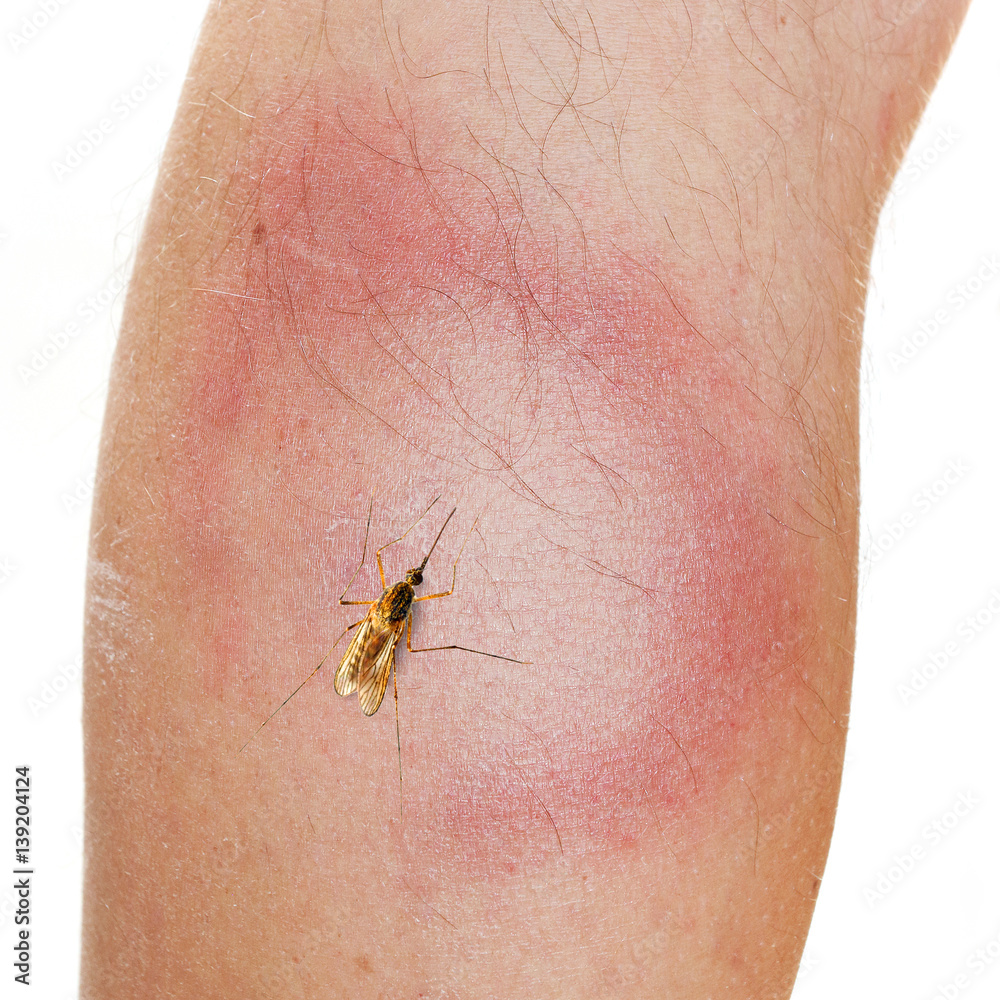 An Erythema Migrans rash often seen in the early stage of Lyme disease