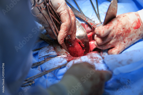 Surgeon pulls uterus out of the body holding by surgical tools close-up during the hysterectomy surgery photo