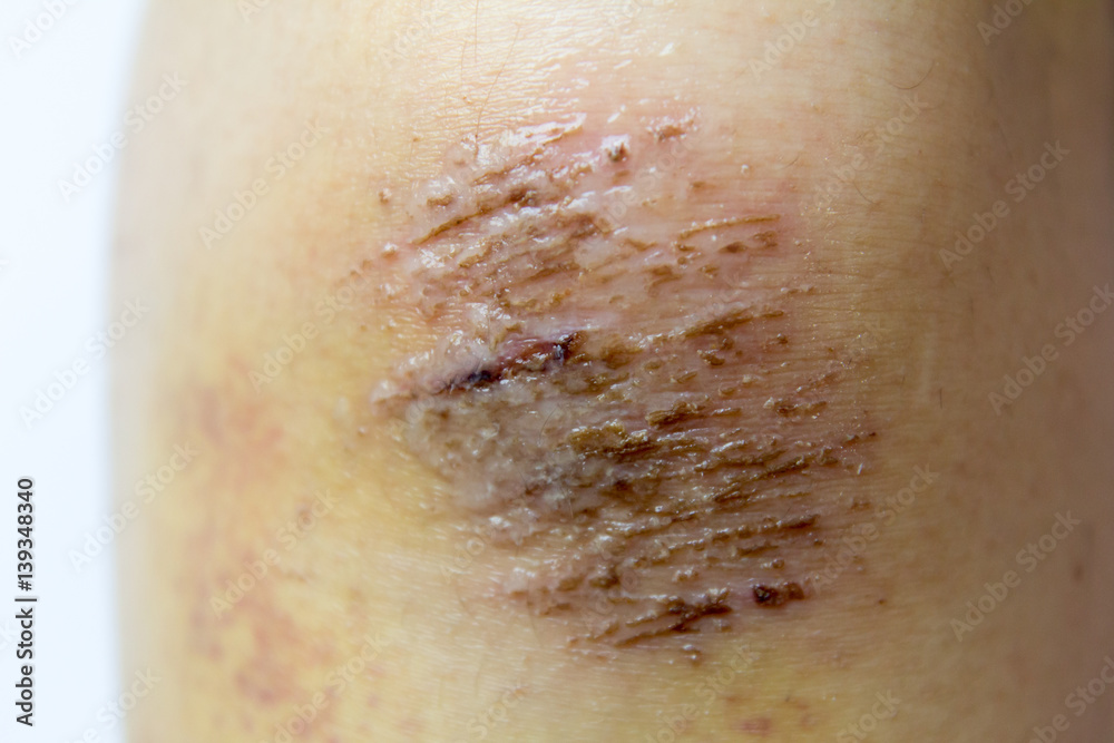 Closed up of red scab injury on knee background Stock Photo | Stock
