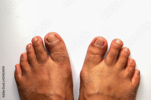 Figure out the nail, Accident nail trauma, bleeding toe nails, Foot ulcers figure out a nail, Onychocryptosis