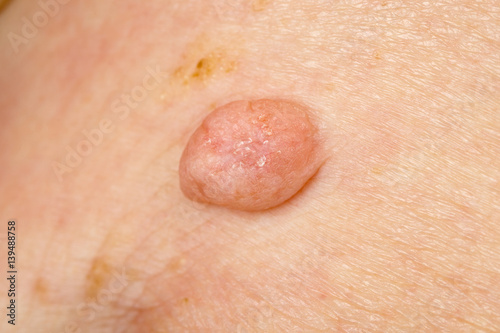 Huge wart on human skin