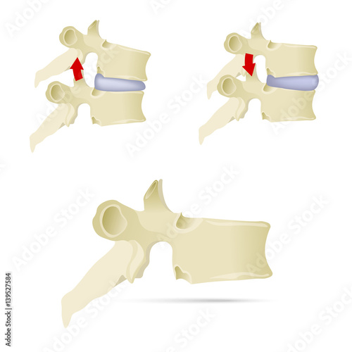 Spine, lumbar vertebra. Facet syndrome, advanced uncovertebral arthrosis, degenerative changes in lumbar vertebra, vertebral bone, lateral view. Flat style, vector illustration photo