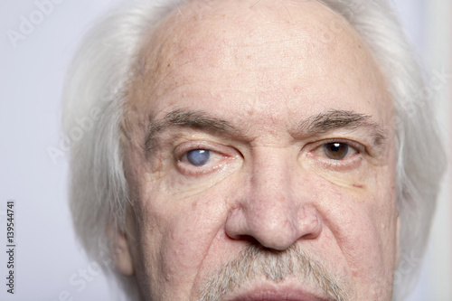Eye disease treatment photo