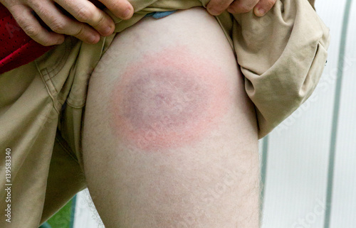Lyme disease bullseye on young mans leg photo