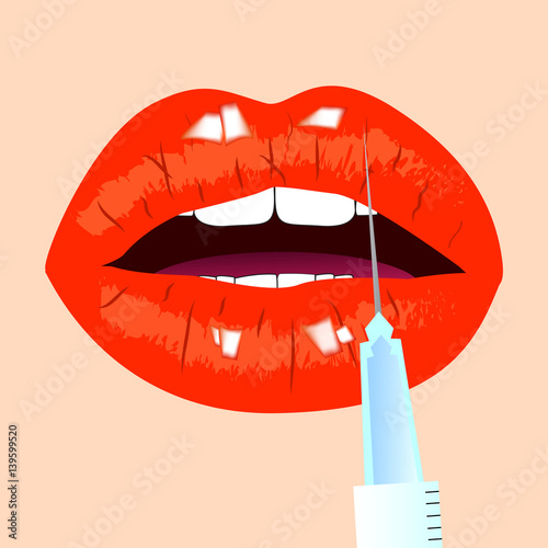 Lips and botox injection. Red lips. Beauty concept, vector illustration