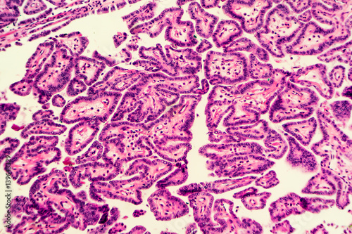 Thyroid cancer: Microscopic image of papillary thyroid carcinoma, characterized by branching papillae with fibrovascular cores.