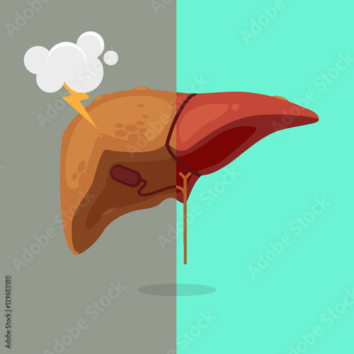 cirrhosis liver illustration