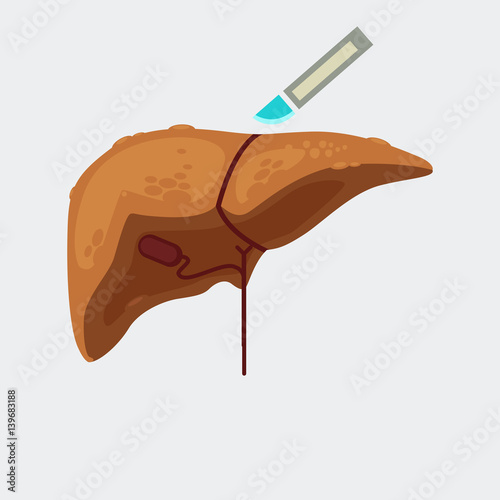 liver cirrhosis vector illustration