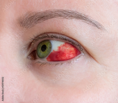 Subconjunctival hemorrhage - hyposphagma