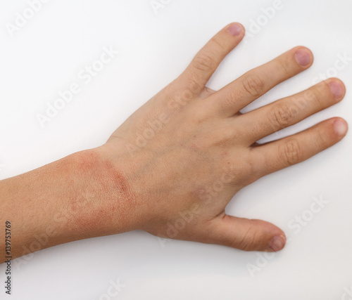 Red spots on child hands skin covered with moisture cream. The cause is winter cold and wind conditions. Light grey background.
