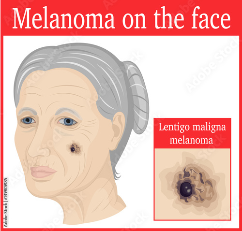 Lentigo maligna melanoma on the cheek of an elderly woman
