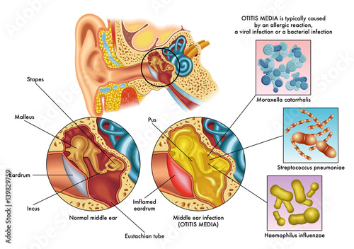 otitis  media
