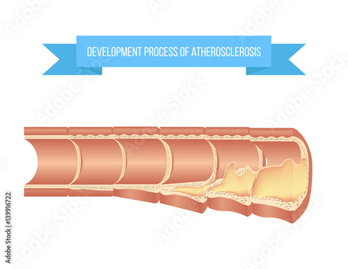 Atherosclerosis process on different stages from healthy vessel to fibroatheroma and complicated lesion