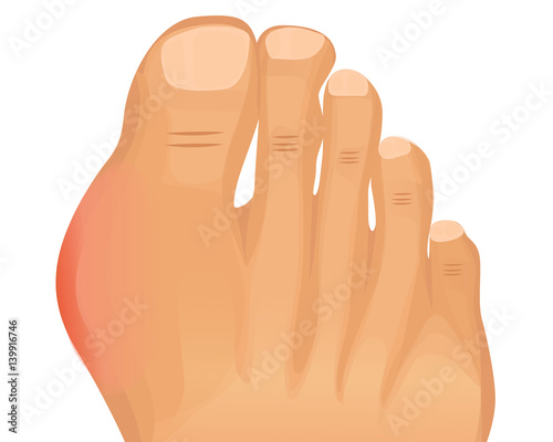Gout illustration. First metatarsophalangeal joint arthritis vector