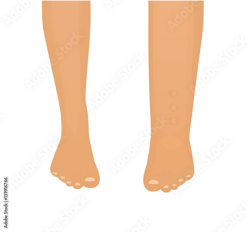 Edema vector illustration. Normal leg with leg with edema