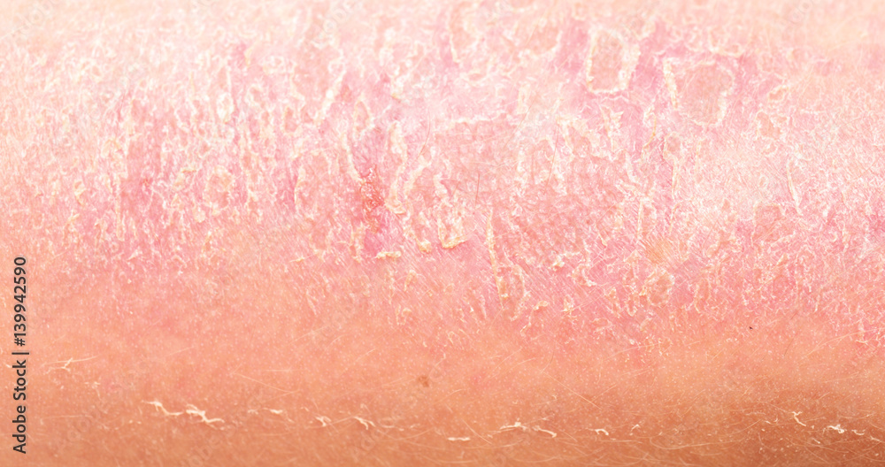 Fototapeta premium sunburn