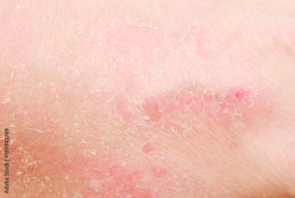 sunburn sunburn