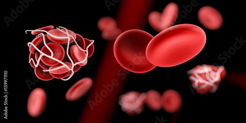 Blood clot and thrombosis medical 3d illustration concept.