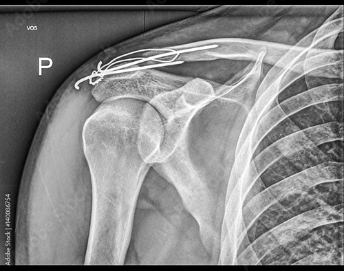 Принти на полотні Broken clavicle bone fixation, Fracture repair