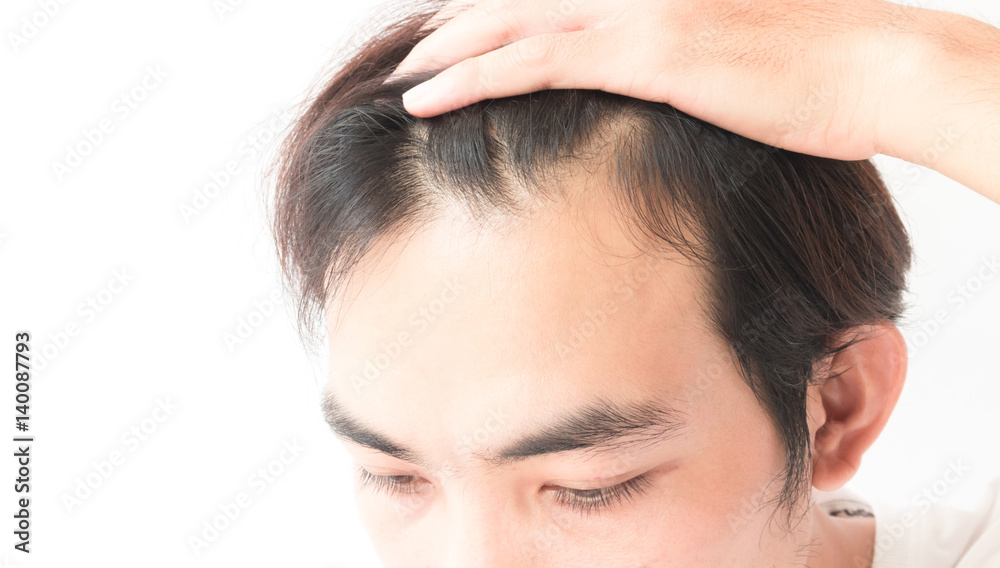 Young man serious hair loss problem for health care shampoo and beauty product concept Young man serious hair loss problem for health care shampoo and beauty product concept