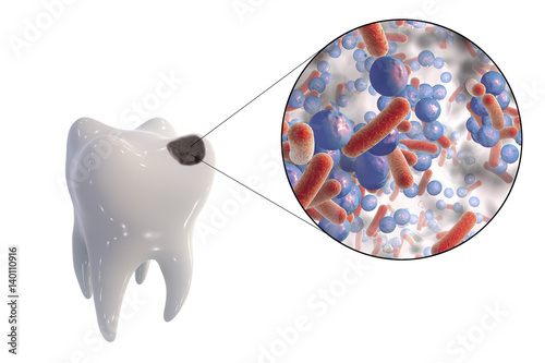 Tooth with dental caries and close-up view of microbes which cause caries, 3D illustration photo