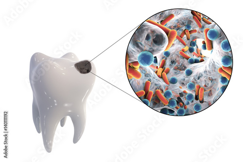Obraz na plátně Tooth with dental caries and close-up view of microbes which cause caries, 3D il
