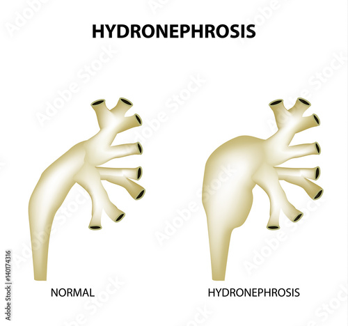Hydronephrosis. Pelvis. Kidney. Infographics. Vector illustration on isolated background