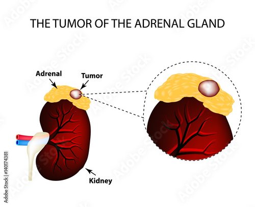A tumor of the adrenal gland. Structure of the kidneys. Vector illustration on isolated background