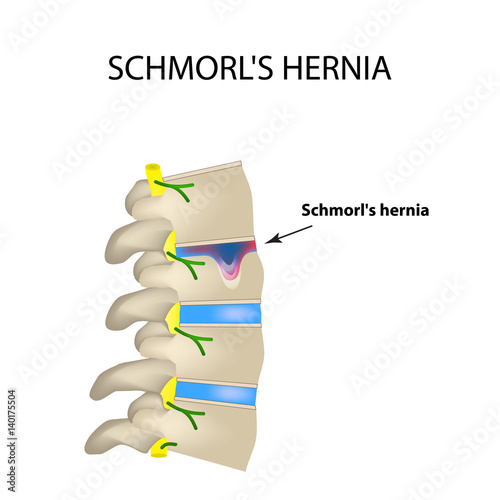Hernia Schmorl. Intervertebral disc. Side view. Spine. Infographics Vector illustration on isolated background