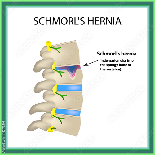 Hernia Schmorl. Intervertebral disc. Side view. Spine. Infographics Vector illustration on isolated background