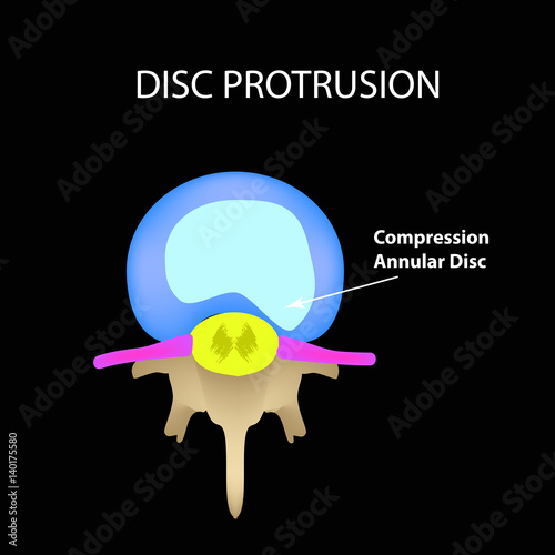 Disc protrusion. Top view. Spine. Infographics. Vector illustration on a black background