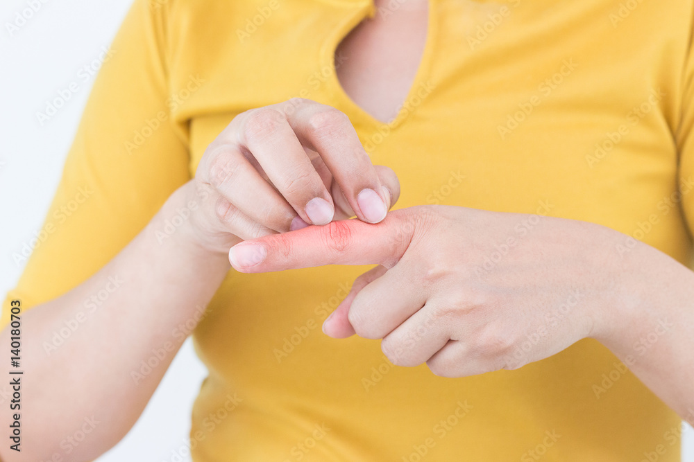 Fototapeta premium Woman scratching the itch on her finger, Healthcare Concept.